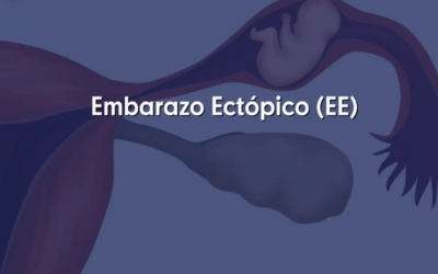 Embarazo ectópico